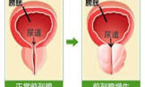 前列腺炎中医辩证的可能病因，治疗可用的伤寒论经方、针炙的穴位及其他可用的中医治疗方法