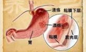 消化性溃疡中医辩证的可能病因，治疗可用的伤寒论经方、针炙的穴位及其他可用的中医治疗方法